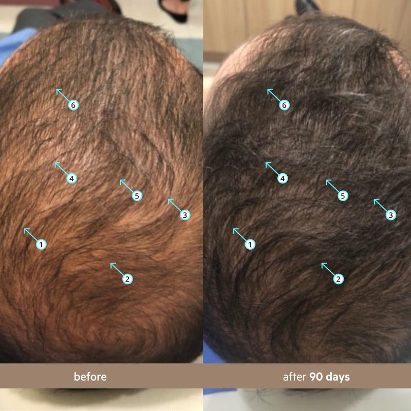 Hair Density Serum with Nanoxidil